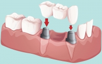 Современная стоматология. Преимущества и недостатки зубных мостов